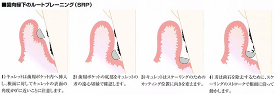 歯周病治療の基本 ~ルートプレーニング(SRP)~
